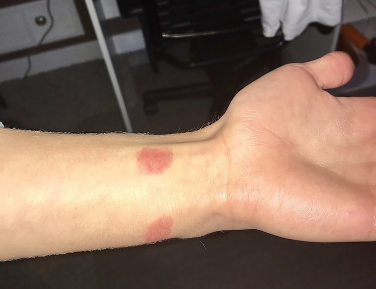 Here’s Why Your Apple Watch Is Leaving Burn Marks on Your Wrist - The ...